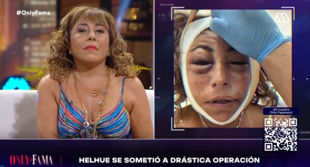 helhue sukni cirugia facial